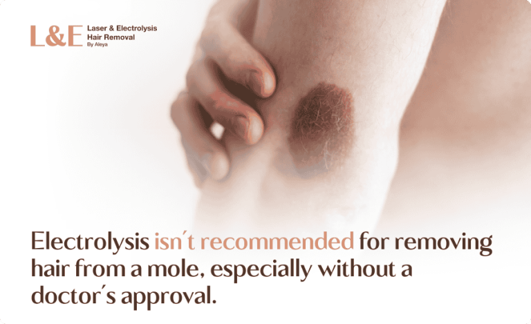 Can You Perform Electrolysis on a Mole With Hair? [+ FAQs]