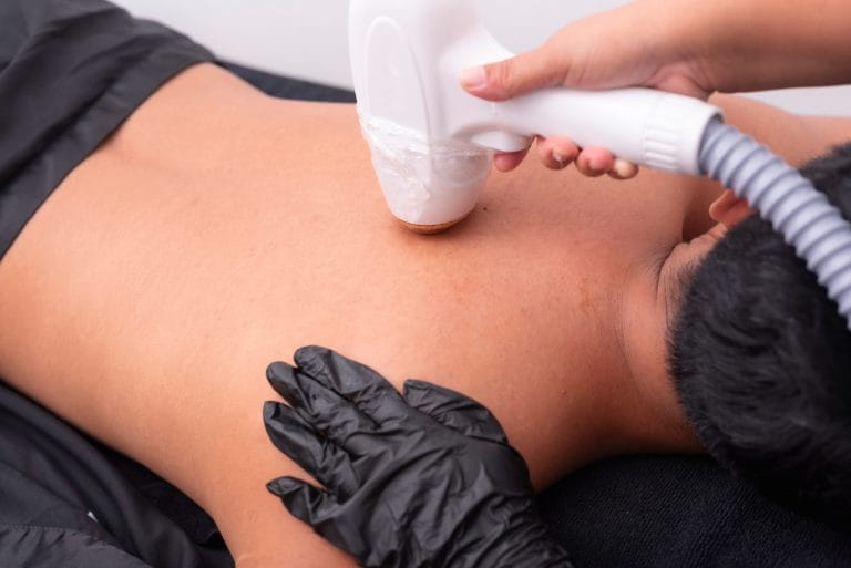Back hair laser removal