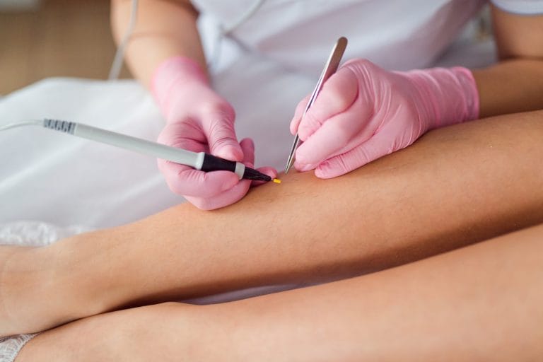 electrolysis-body-hair-removal