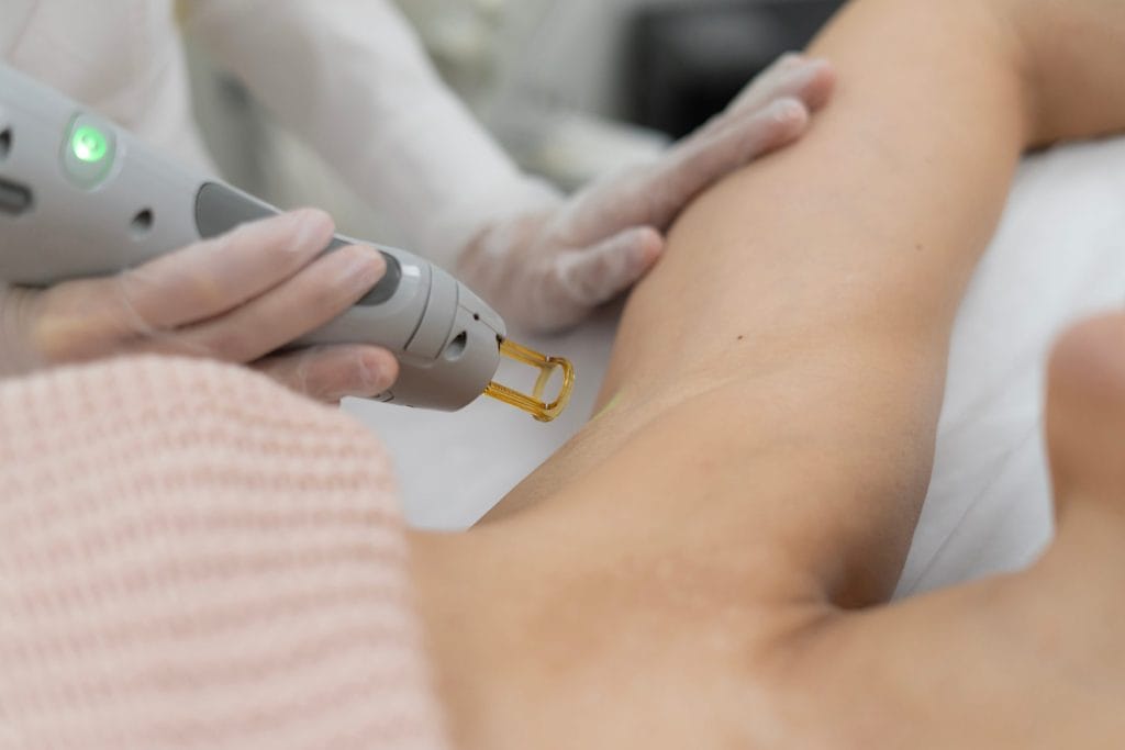How does laser hair removal work heat damage