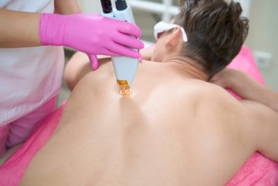 Back laser hair removal