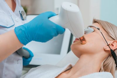 Upper lip laser hair removal