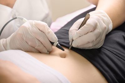 Full body electrolysis hair removal process step 3