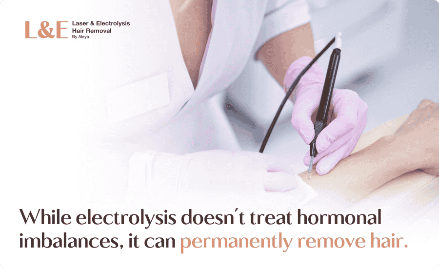 PMOS Hair Removal: Is Electrolysis Right For You?