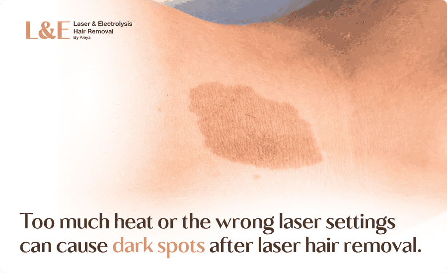 Laser Hair Removal and Hyperpigmentation: Is It Possible?