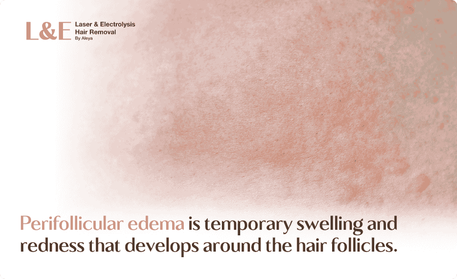 Perifollicular Edema: Why Skin Swells After Laser Hair Removal