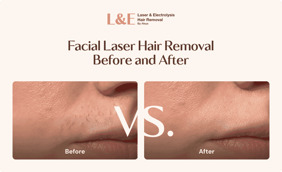 An infographic highlighting facial laser hair removal before and after results