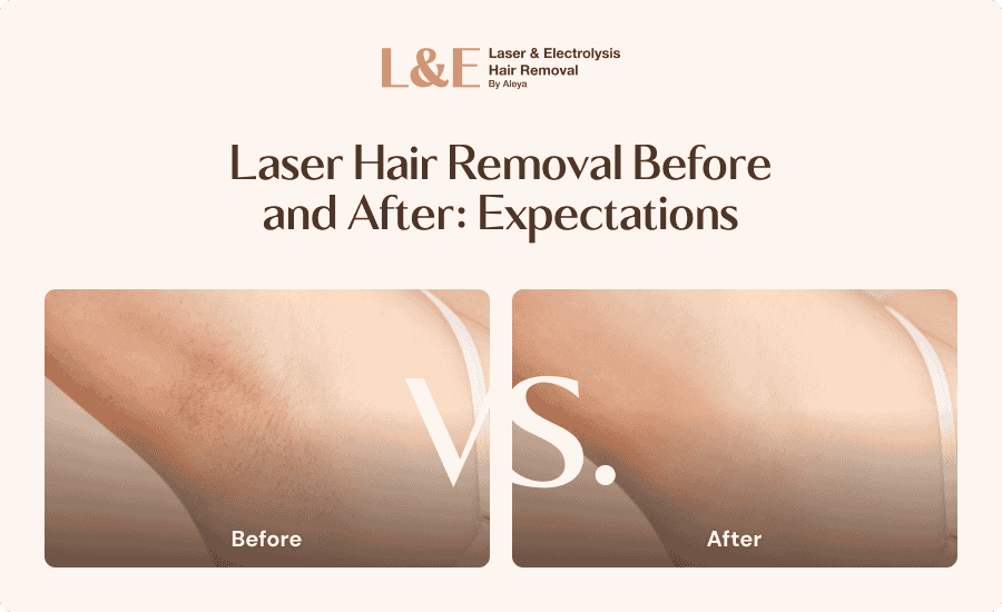 Laser Hair Removal Before and After: What Results Can You Expect?
