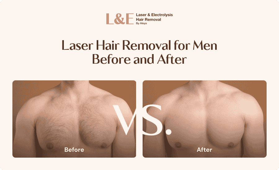 An infographic highlighting male laser hair removal before and after results