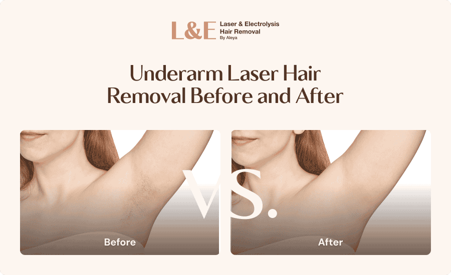 An infographic highlighting underarm laser hair removal before and after results